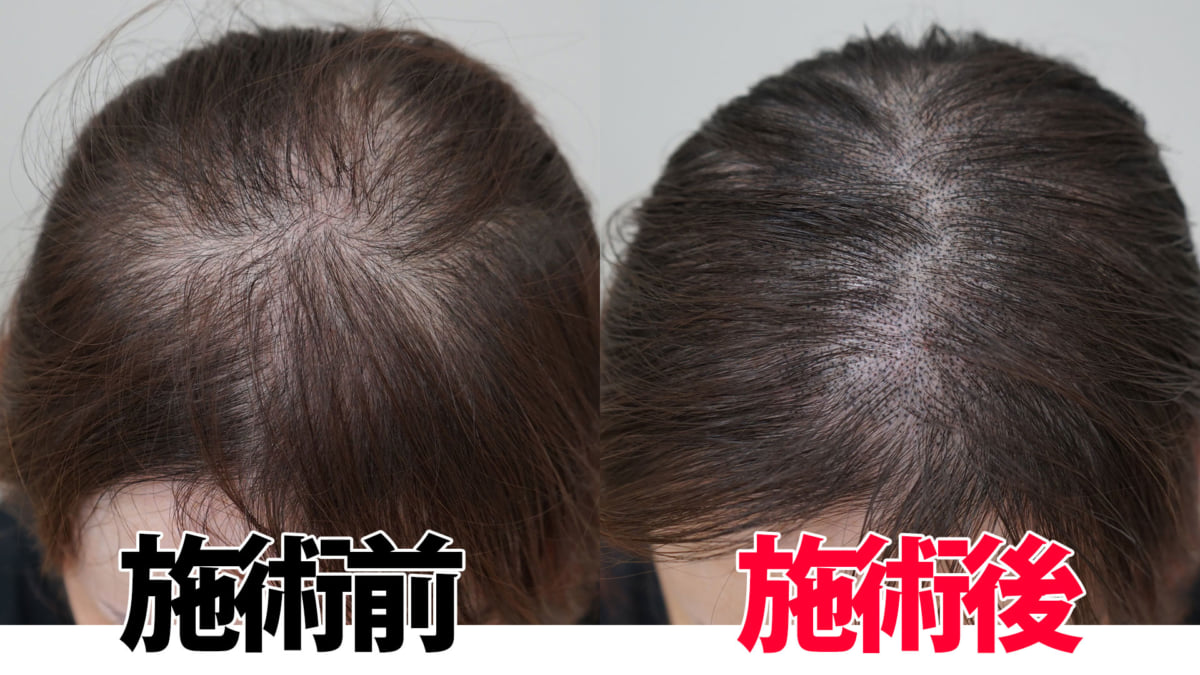 40代薄毛女性が頭皮タトゥーを体験 Spj東京クリニック体験レポ 美髪と