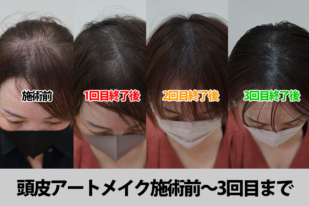 頭皮タトゥー アートメイク 2回目 3回目 Spj東京クリニック体験レポ 美髪と
